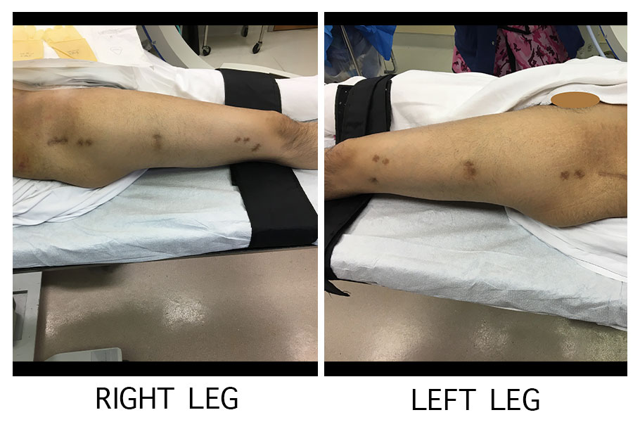 Height Lengthening procedure