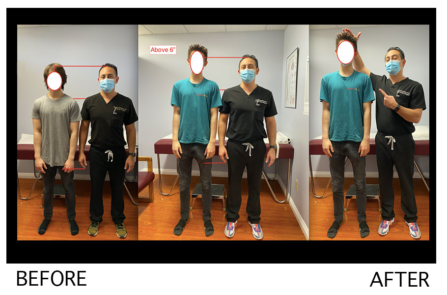 Height Lengthening procedure