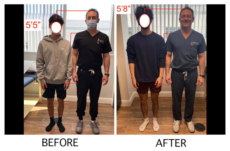 Before & After Gallery Height Lengthening
