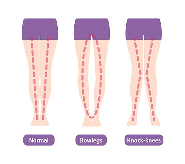 Knock Knee Deformity