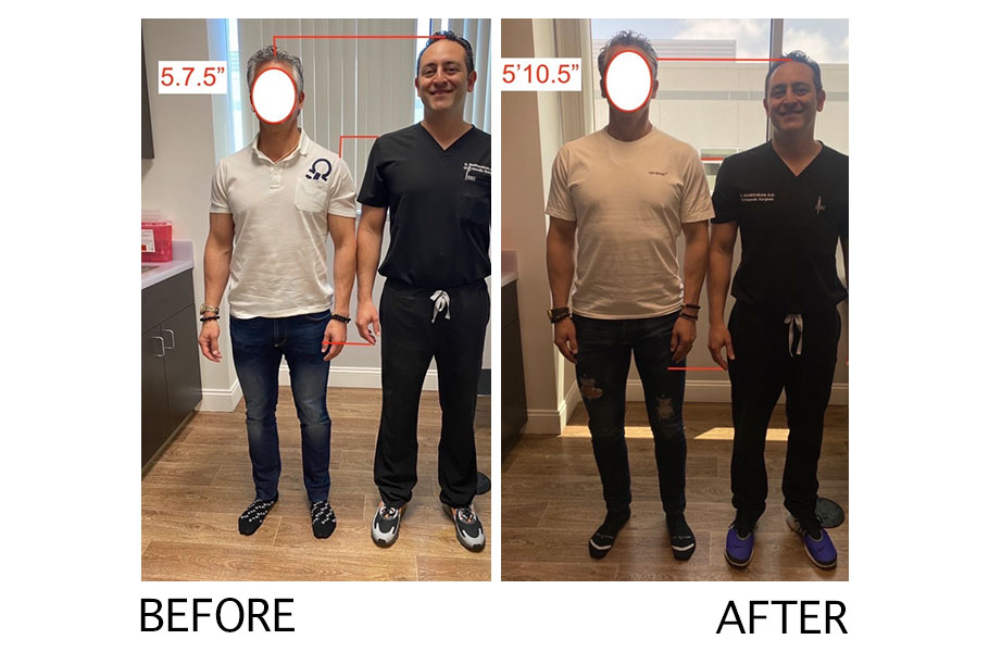 Height Lengthening procedure