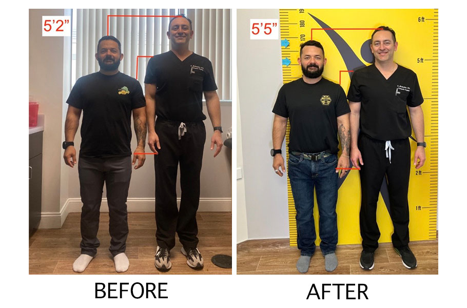 Height Lengthening procedure